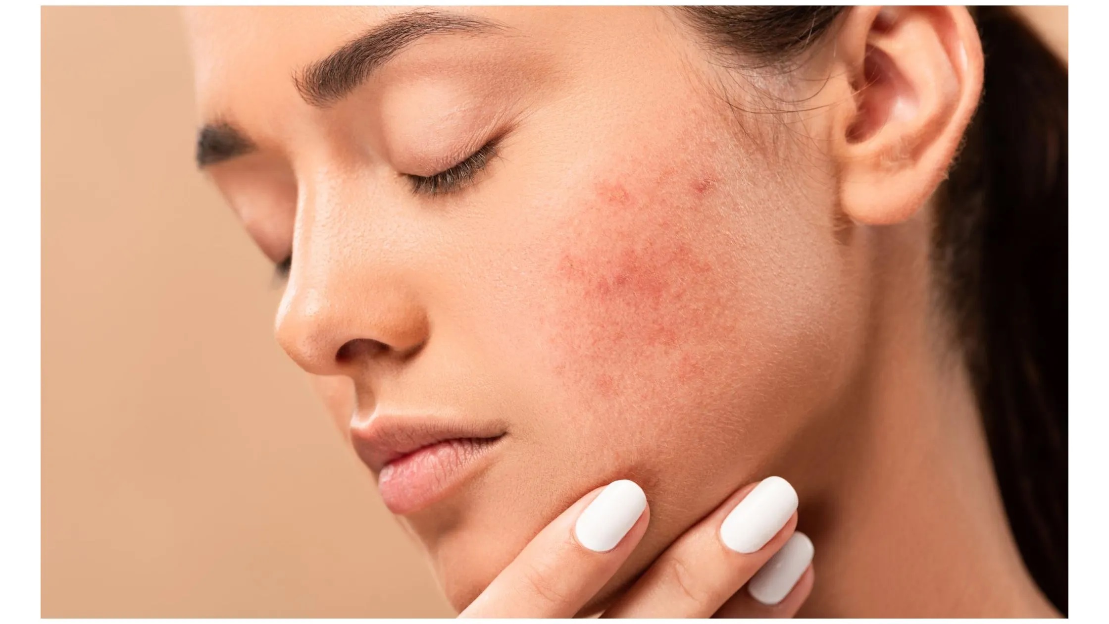 Marks On Face: ये आसान घरेलू उपायों से चश्मे के निशानों को हटाएं और चमकदार चेहरा पायें|