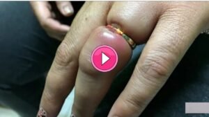 Desi Jugaad बिना किसी झंझट के ऊँगली में फंसी अंगूठी को निकालने का सरल उपाय, देखे वीडियो