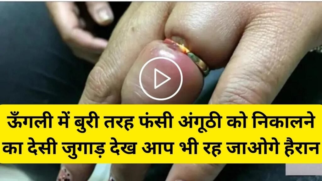 Desi Jugaad: ऊँगली में बुरी तरह फंसी अंगूठी को निकालने का देसी जुगाड़ देख आप भी रह जाओगे हैरान, देखे वायरल वीडियो